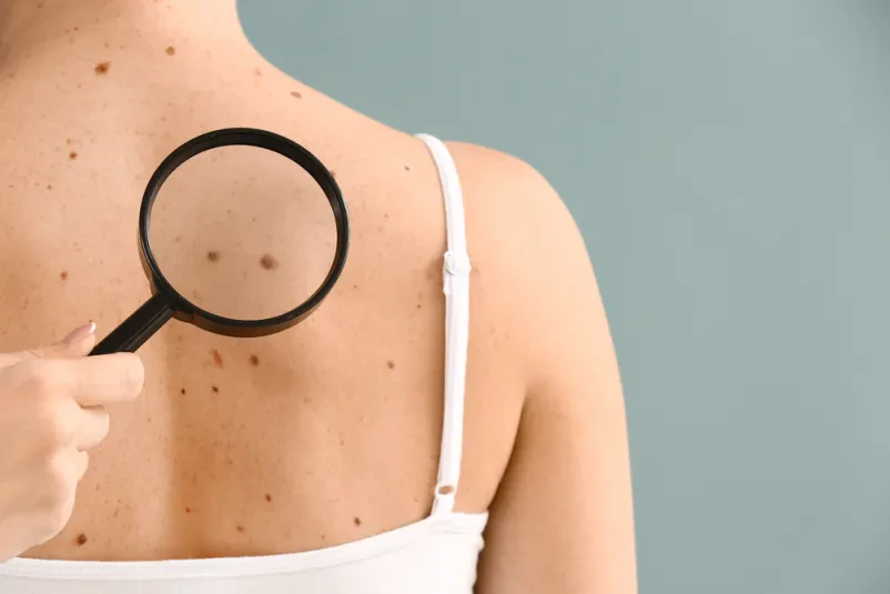 Dermatološki pregledi in posegi Obala