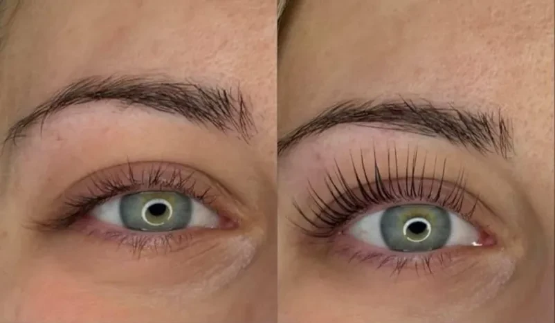 Keratinsko vihanje trepalnic Osrednja Slovenija