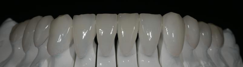 Kvalitetni zobni venirji Ljubljana Šiška