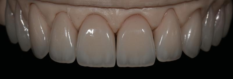 Strokovna izdelava zobnih venirjev Ljubljana