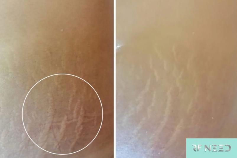 Radiofrekvenčni needeling Portorož, Obala