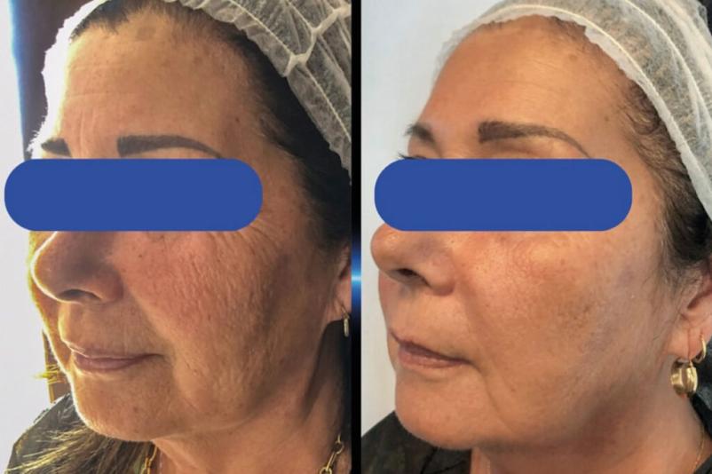 Pomlajevanje kože z mikroiglicami Obala