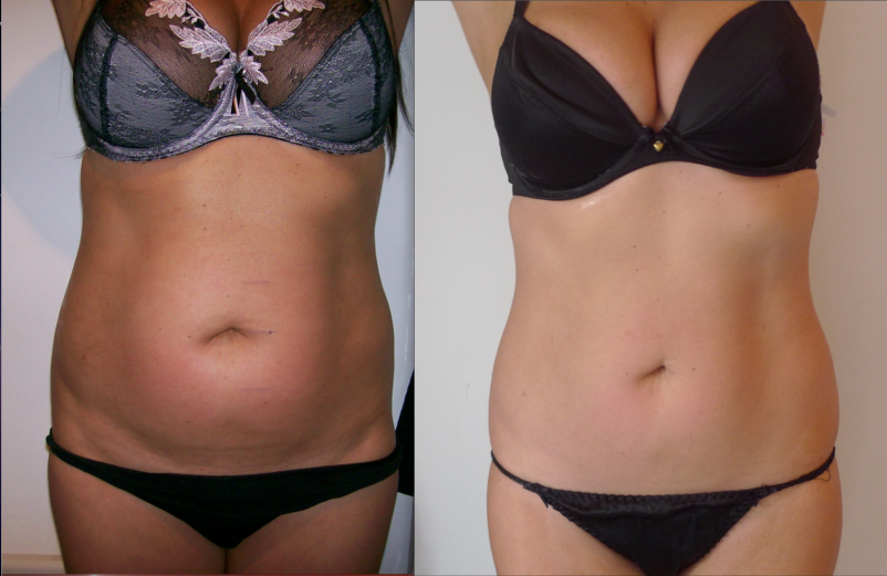 Terapija proti ohlapnosti kože Brezovica