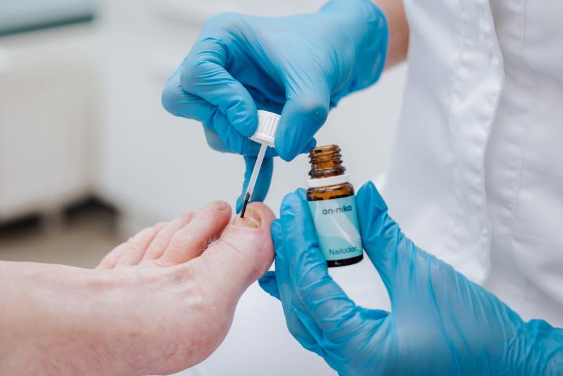 Reševanje glivičnih okužb nohtov po metodi AN.NIKA