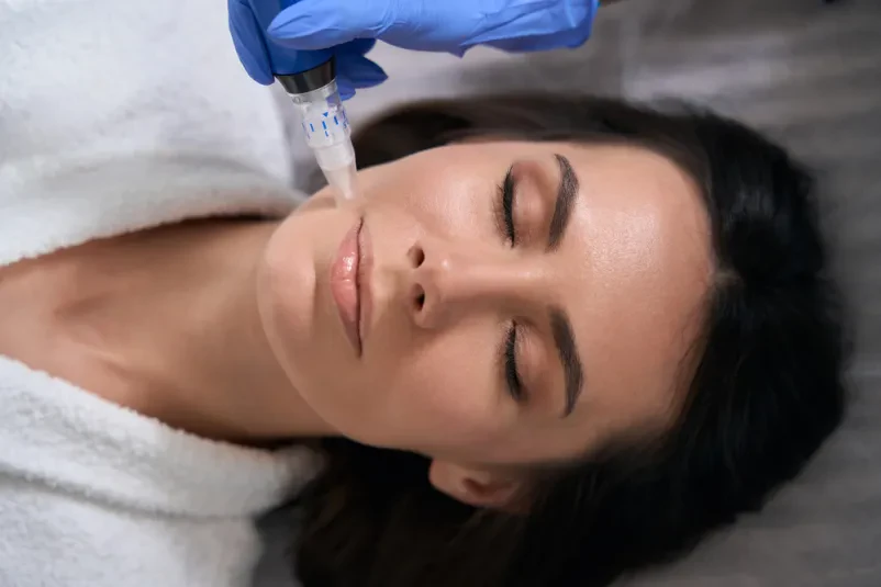 Ponudba za microneedling Ljubljana