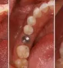 Implantati ljubljana bezigrad