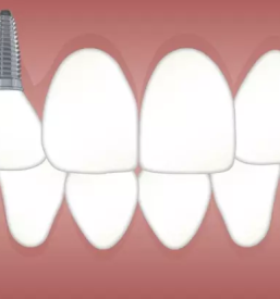 Stomatološka protetika Kranj