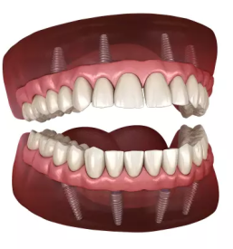 Invisalign cena krsko dolenjska