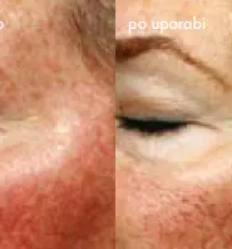 Kolagenske niti nega obraza v ljubljani