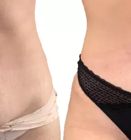 Liposukcija po porodu Slovenija