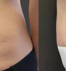 Abderoplastika v Sloveniji