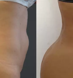 Kvalitetna abderoplastika v Sloveniji