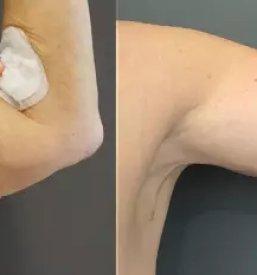 Abderoplastika Slovenija