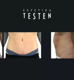 Liposukcija trebuha Slovenija
