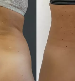 Ugodna liposukcija Štajerska, Slovenija