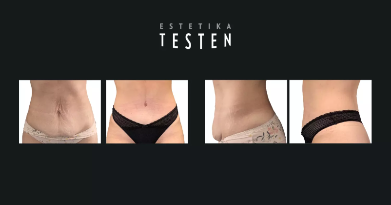 Kvalitetna liposukcija v Sloveniji