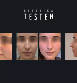 Rinoplastika Slovenija