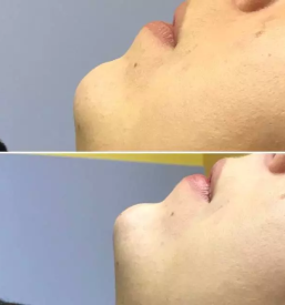 Kvalitetna rinoplastika Slovenija