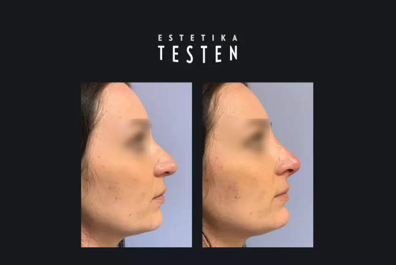 Kvalitetna rinoplastika v Sloveniji