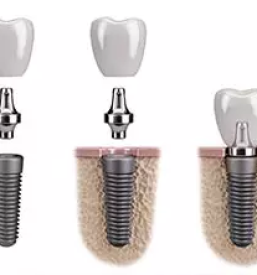 Kvalitetni zobni implantati ljubljana