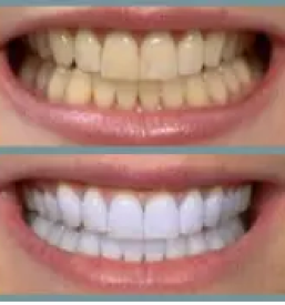 Kvalitetni zobni implantati ljubljana