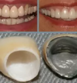 Kvalitetni zobni implantati ljubljana