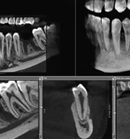 Kvalitetni zobni implantati ljubljana