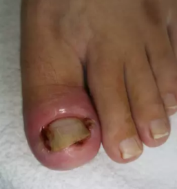 Medicinska pedikura maribor