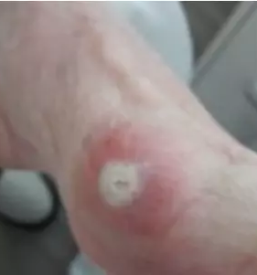 Medicinska pedikura maribor