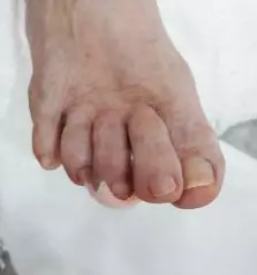 Medicinska pedikura maribor