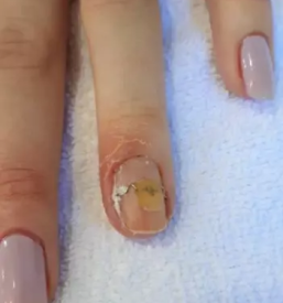 Medicinska pedikura maribor