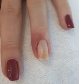 Medicinska pedikura maribor