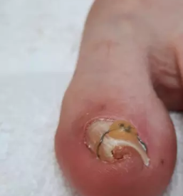 Medicinska pedikura maribor