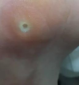 Medicinska pedikura maribor