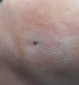 Medicinska pedikura maribor