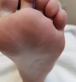 Medicinska pedikura maribor