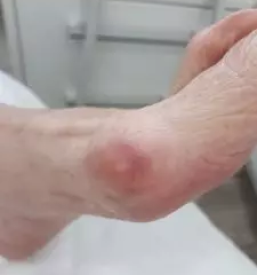 Medicinska pedikura nova gorica