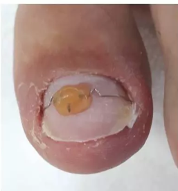 Medicinska pedikura nova gorica