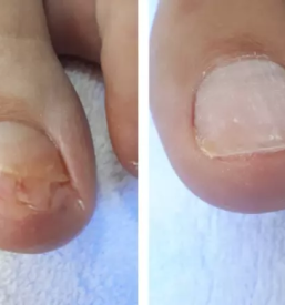 Medicinska pedikura nova gorica