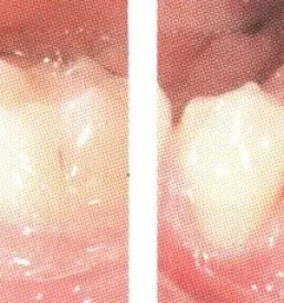 Nevidni zobni aparati