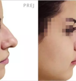 Augmentacija prsi Slovenija