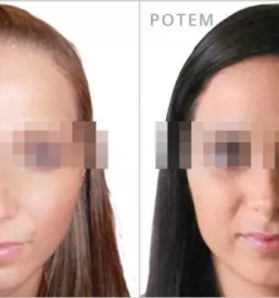 Povečanje prsi Slovenija