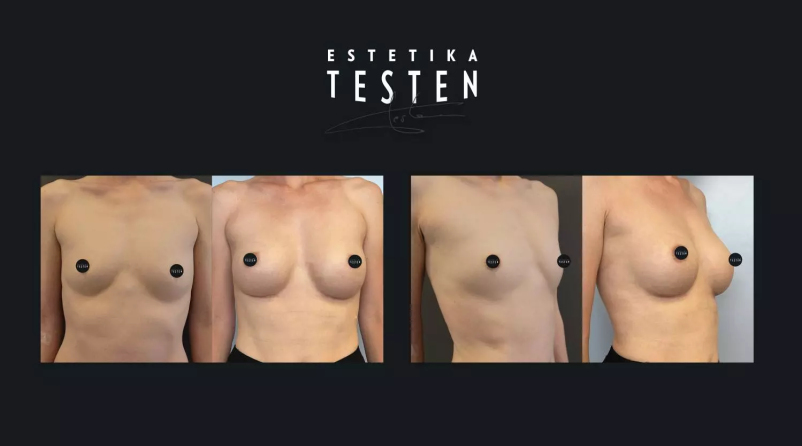 Ugodno in zanesljivo povečanje prsi Slovenija