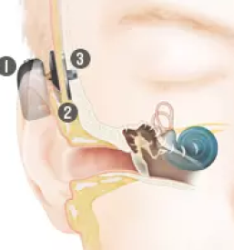 Slušni aparati Slovenija