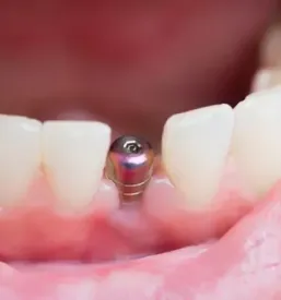 Invisalign 