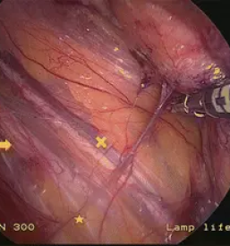 kirurg za športnikovo kilo