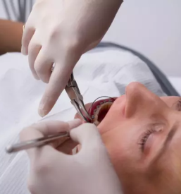 Implantati cena posavje