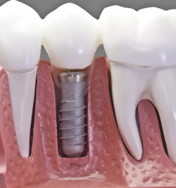 Zobni implantati Kranj