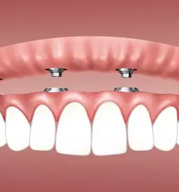 Dobra implantologija stajerska