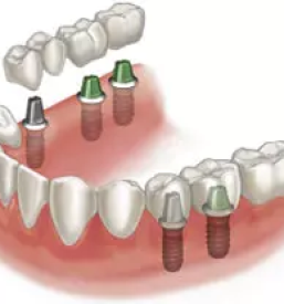 Kvalitetna izdelava implantatov maribor